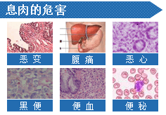 部疾病 肠息肉       医生表示肠息肉可分为以下几种:   1,腺瘤性息肉